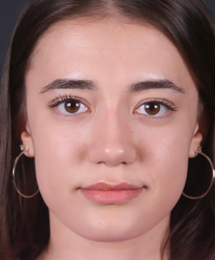 burun estetigi oncesi sonrasi