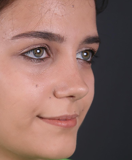 burun ucu estetigi oncesi ve sonrasi