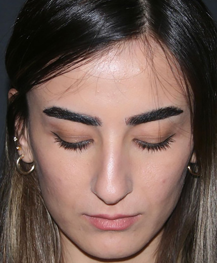 sekonder burun estetigi oncesi ve sonrasi